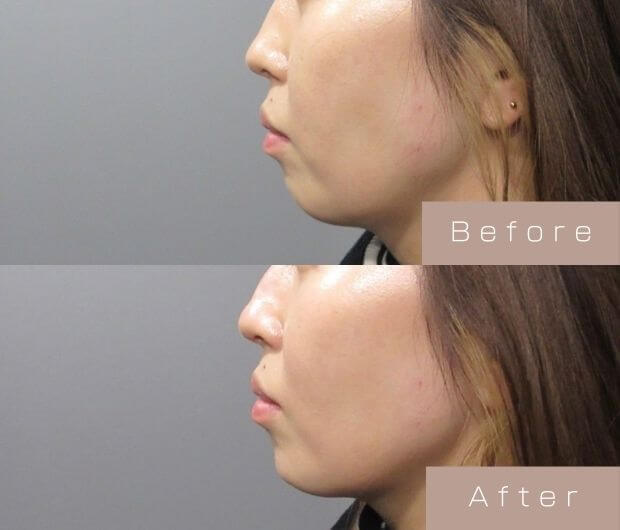 鼻・顎ヒアルロン酸