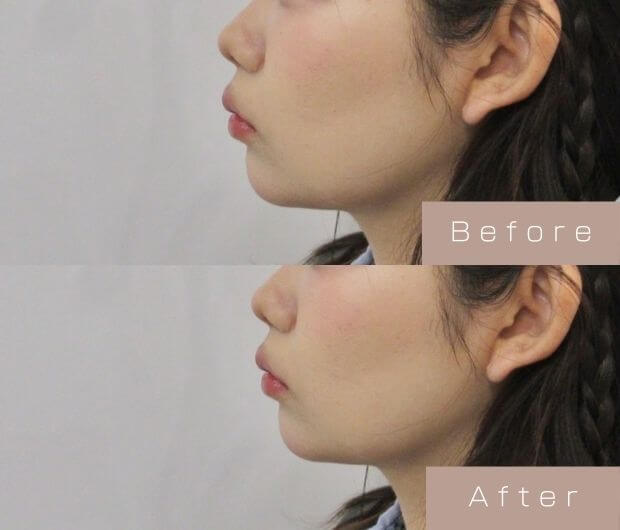 鼻・顎ヒアルロン酸