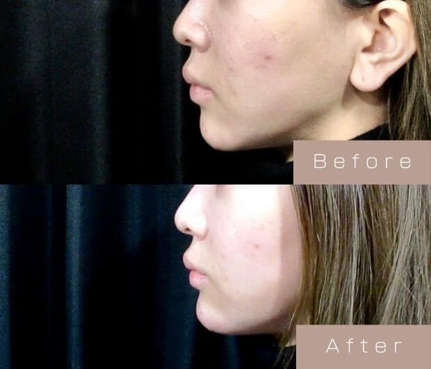 鼻・顎ヒアルロン酸