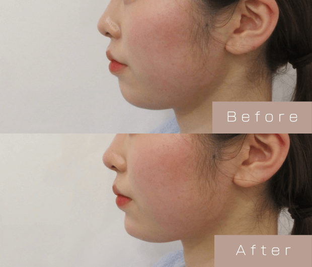 鼻・顎ヒアルロン酸