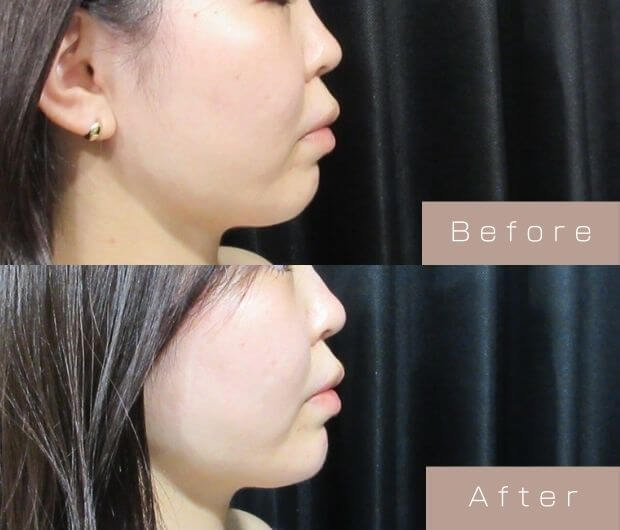 鼻・顎ヒアルロン酸
