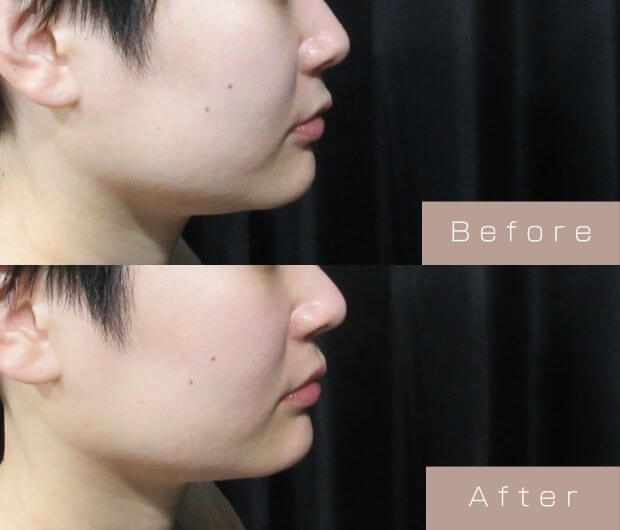 鼻・顎ヒアルロン酸