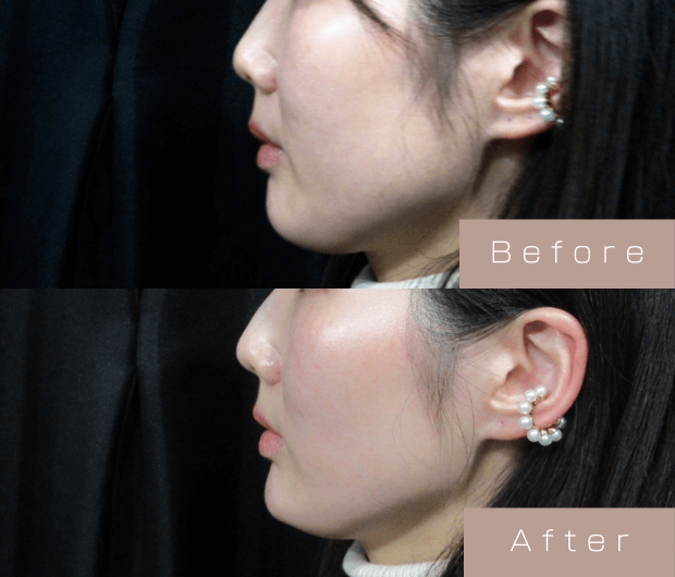 鼻・顎ヒアルロン酸