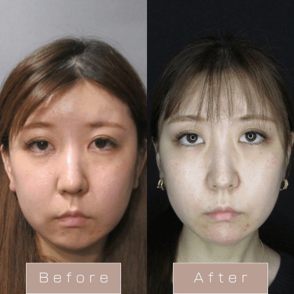 PDO6本＋顎ヒアルロン酸