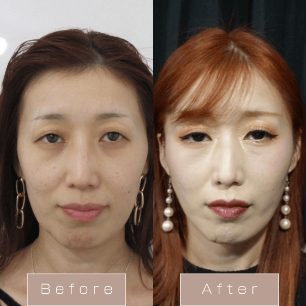 糸リフト（WPCL）８本