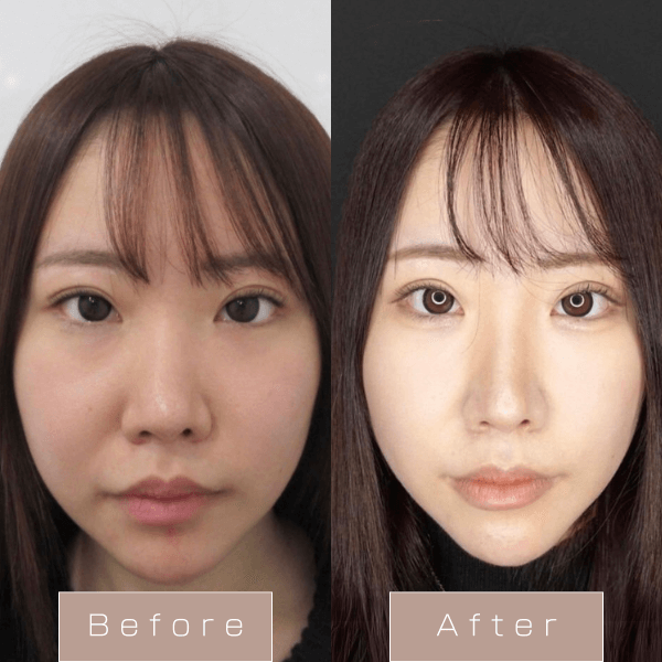 糸リフト（WPCL）８本