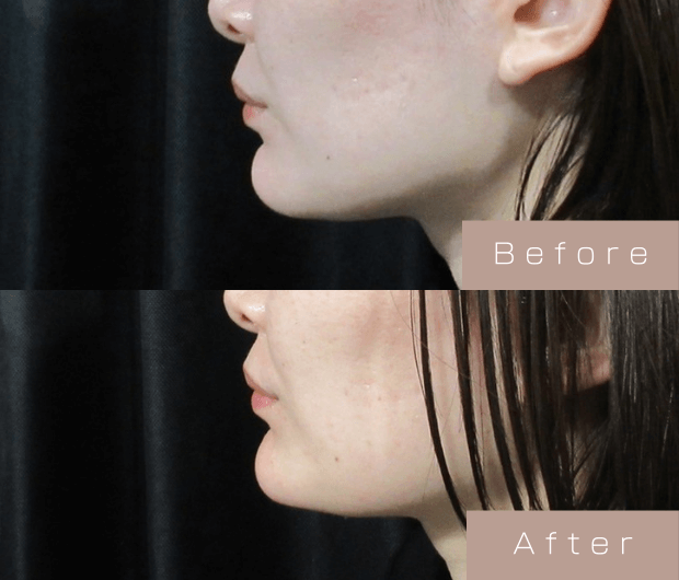 顎ヒアルロン酸